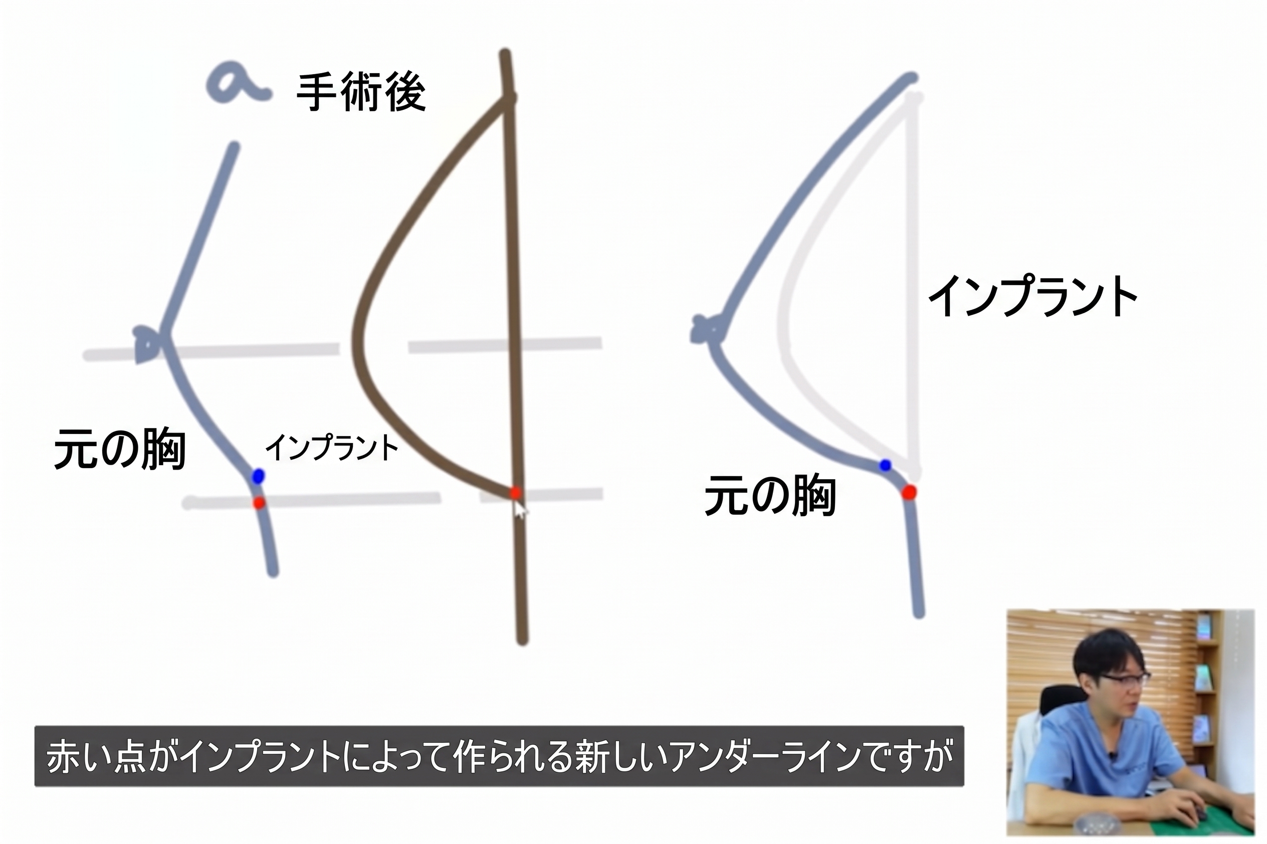 豊胸手術の決定時に重要な2つのポイントとは? (6)