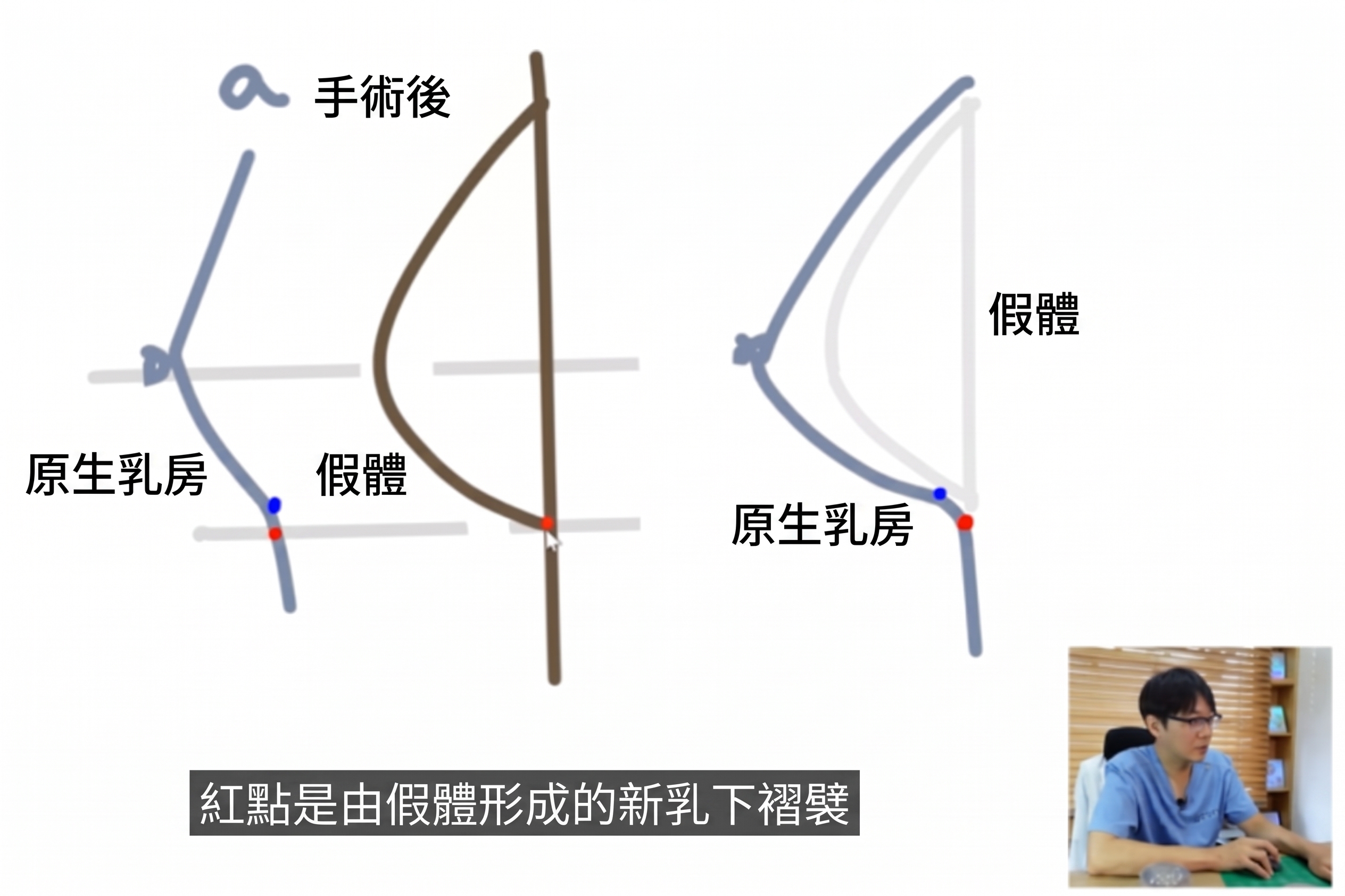 決定植入物隆乳手術時的兩大關鍵? (6)