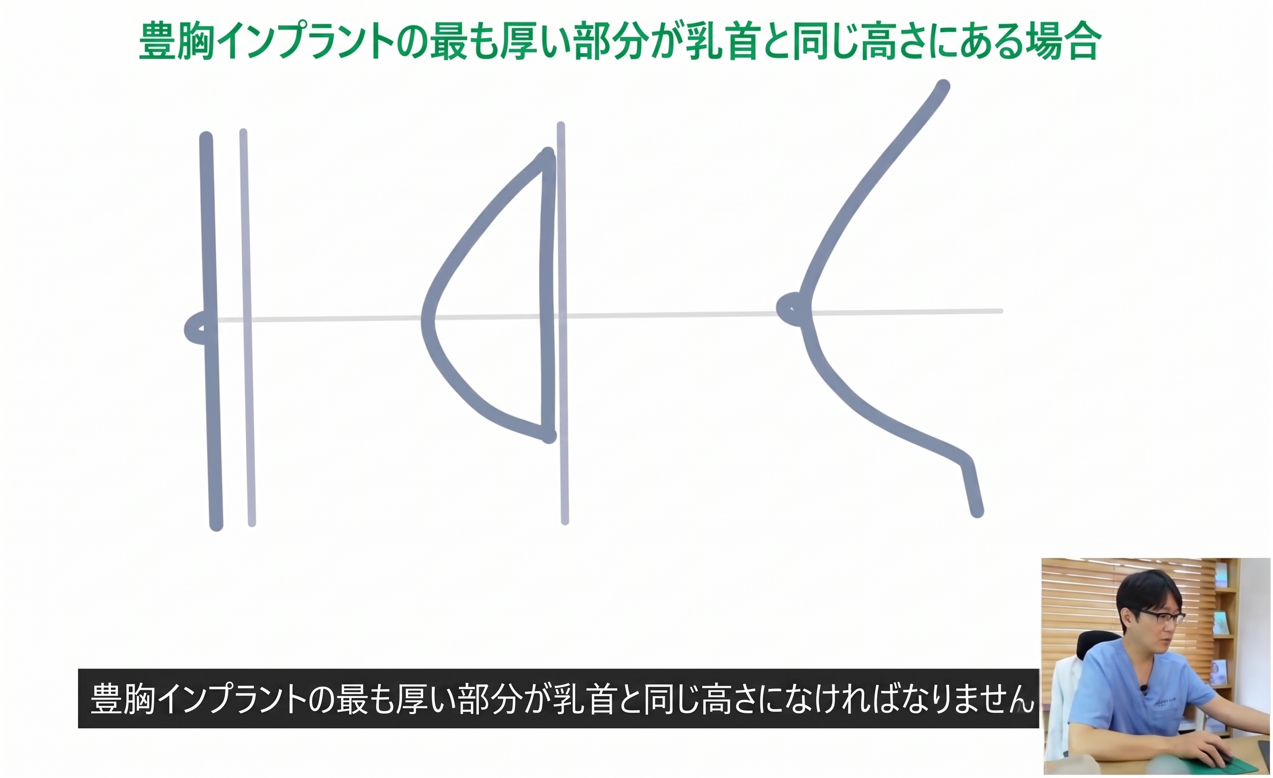 豊胸手術の決定時に重要な2つのポイントとは？ (3)