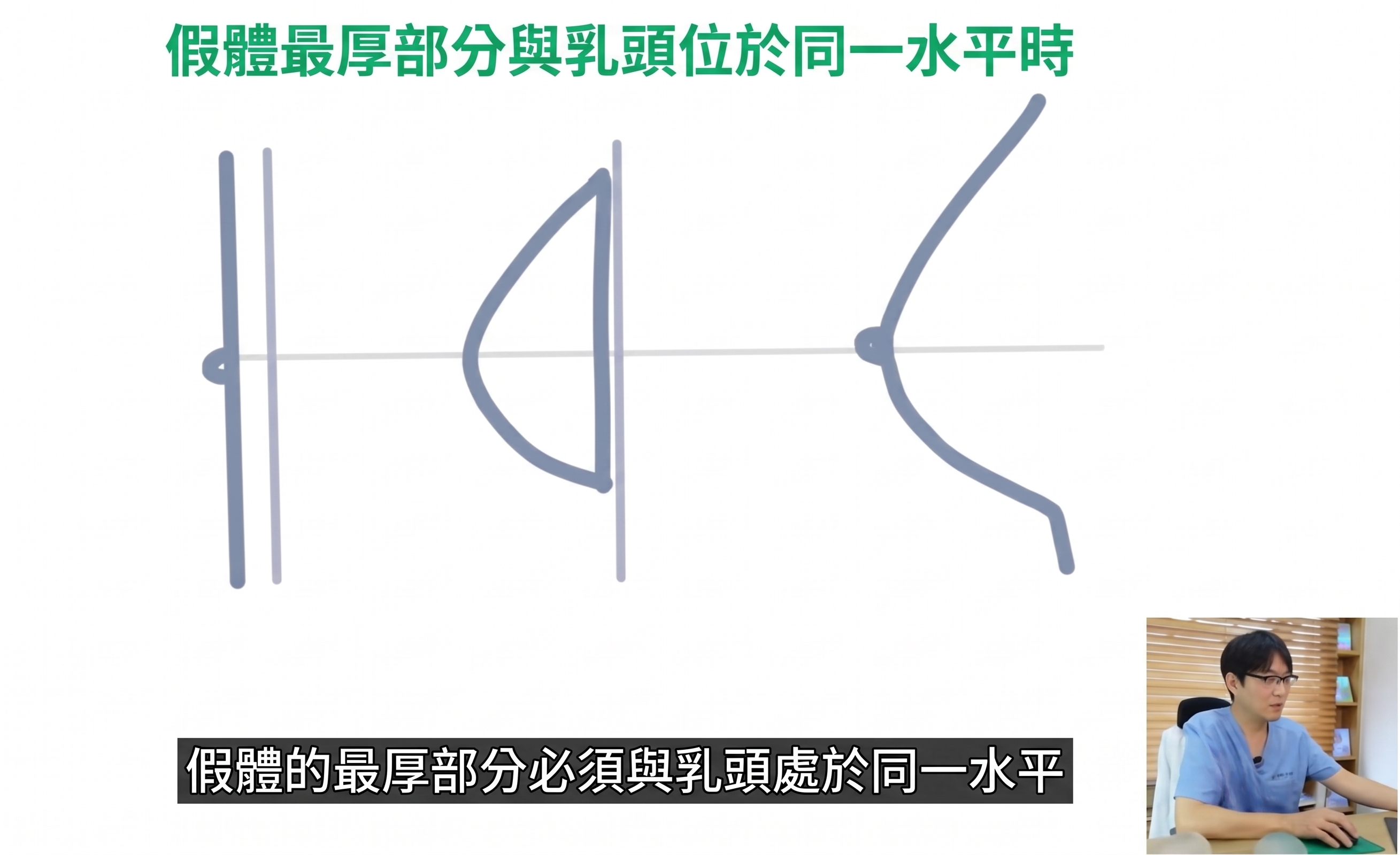 決定植入物隆乳手術時的兩大關鍵? (3)